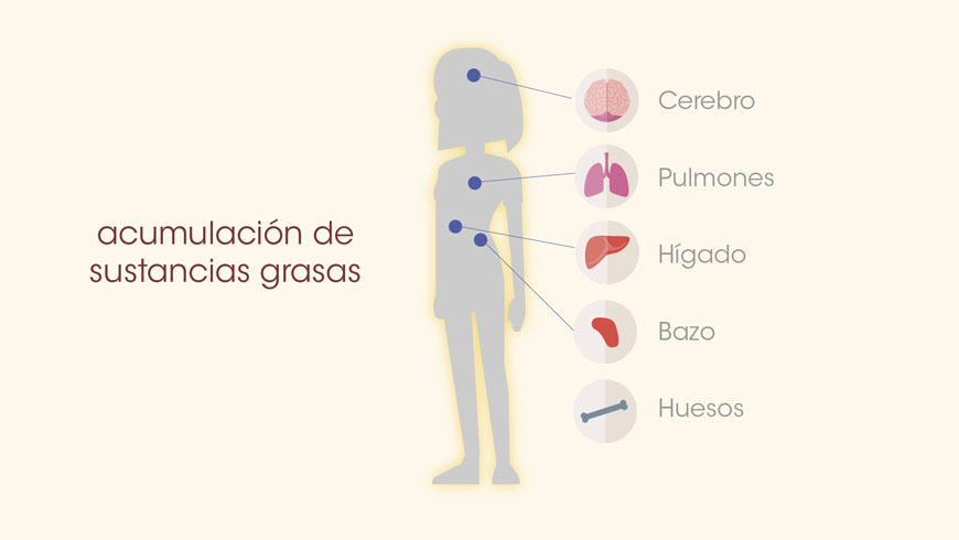 Enfermedad de Gaucher